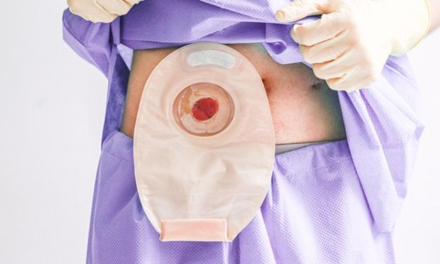 Prosedur Bedah Stoma Membuat Lubang Di Bagian Perut