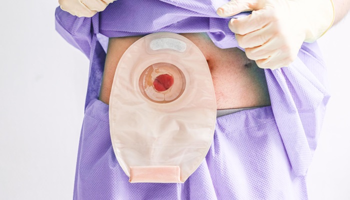 Prosedur Bedah Stoma Membuat Lubang Di Bagian Perut